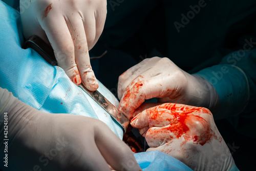The bloody hands of surgeons in sterile gloves work with a medical instrument during a surgical operation.