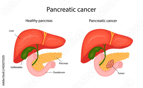 pancreatic cancer. infographics. vector illustration in cartoon style.