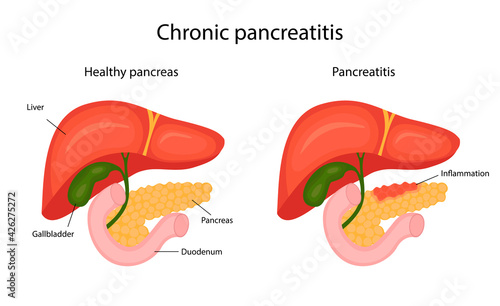 disease pancreatitis, infographic. liver and pancreas. vector illustration in cartoon style.