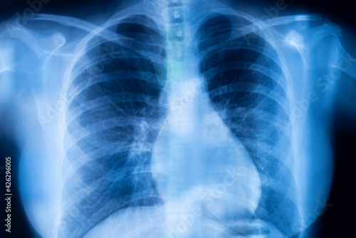 Lungs ribs xray scan