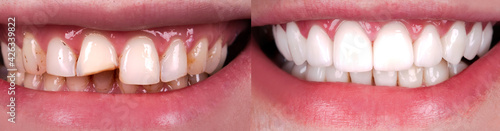 Perfect smile before and after veneers bleach of zircon arch ceramic prothesis Implants crowns. Dental restoration treatment clinic patient . Result of oral surgery procedure whitening dentistry