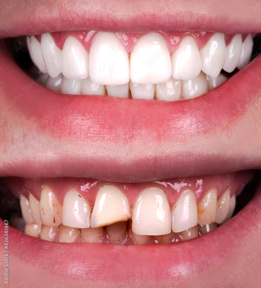 Fototapeta premium Perfect smile before and after veneers bleach of zircon arch ceramic prothesis Implants crowns. Dental restoration treatment clinic patient . Result of oral surgery procedure whitening dentistry