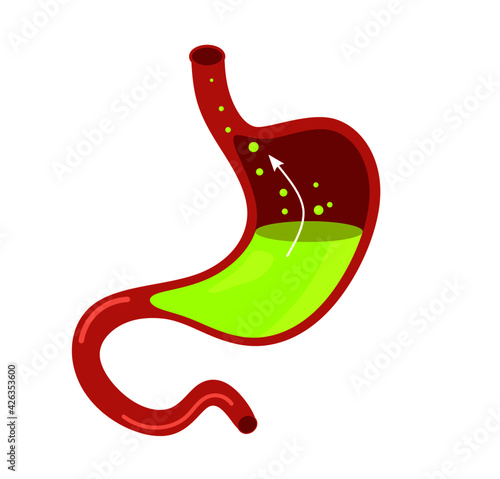 Acid reflux or gastroesophageal reflux, Heartburn. Gastric disease, stomach problem disease concept. Human stomach full of gastric acid, cut view and flat vector illustration