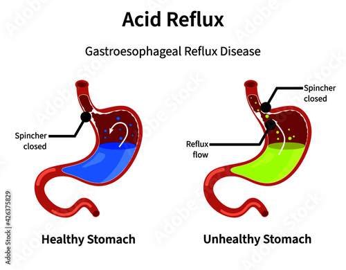 Acid reflux or gastroesophageal reflux, Heartburn. Gastric disease, stomach problem disease concept. Healthy and unhealthy Human stomach full of gastric acid, cut view and flat vector illustration