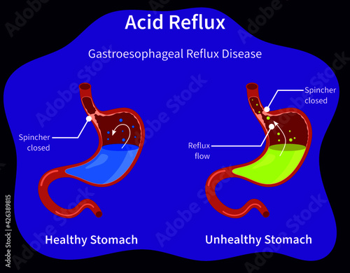 Acid reflux or gastroesophageal reflux, Heartburn. Gastric disease, stomach problem disease concept. Healthy and unhealthy Human stomach full of gastric acid, and flat vector illustration - Dark bg