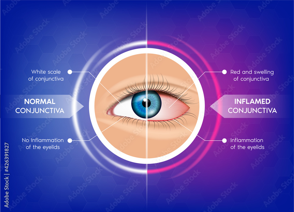 Normal conjunctiva and Conjunctivitis. Healthy eye and pink eye. Most