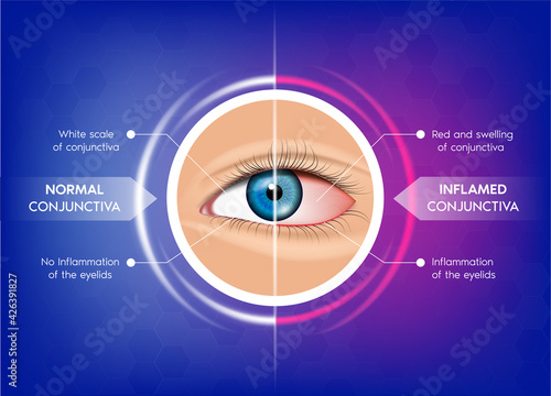 Normal conjunctiva and Conjunctivitis. Healthy eye and pink eye. Most common eye problems glaucoma, dry eye syndrome. Human eye anatomy in front view. 3D Vector EPS10 illustration photo