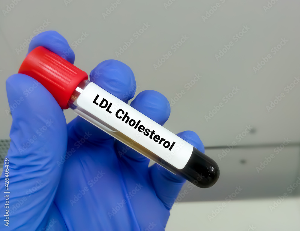 Blood sample for LDL cholesterol test, LDLC, Bad cholesterol, lipid