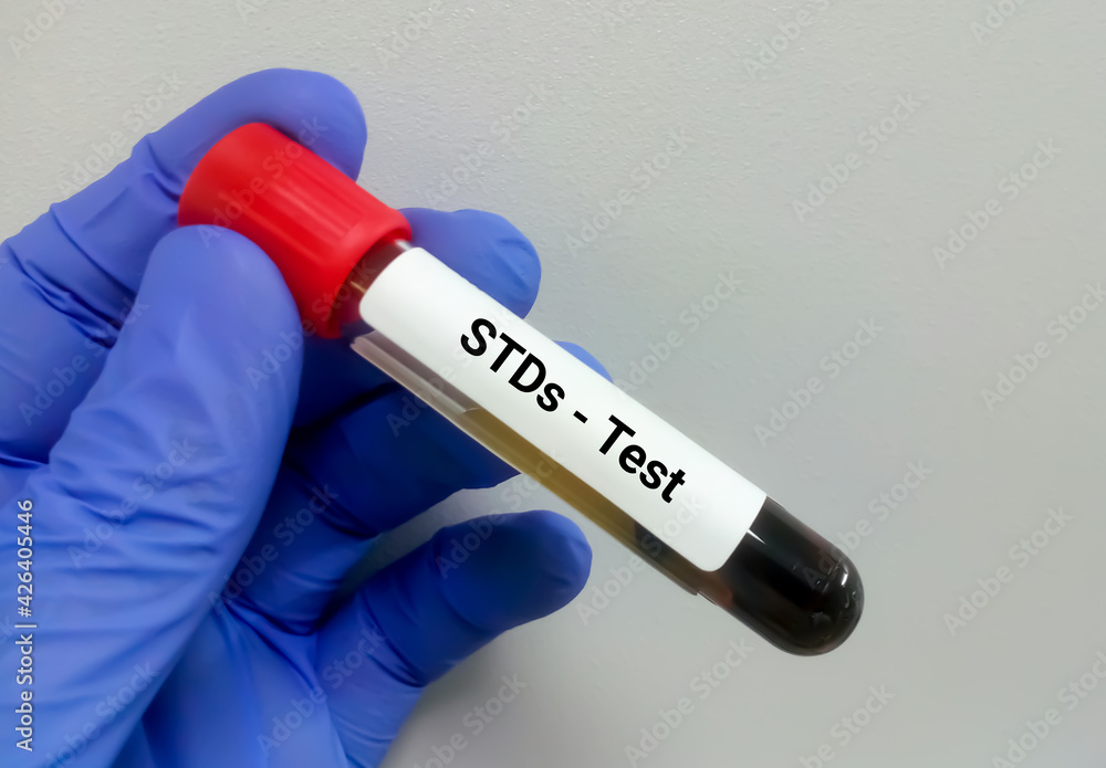 Fototapeta premium Blood sample for STDs (Sexually transmitted diseases) test