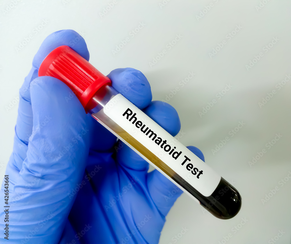 Blood sample with laboratory requisition form for rheumatoid factor (RF) test. diagnosis for