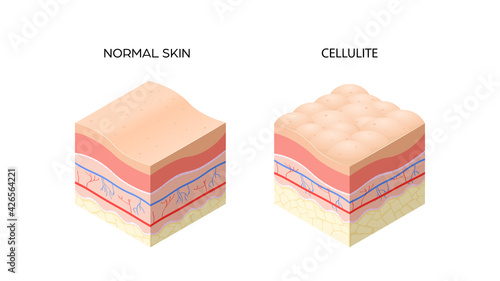 skin with cellulite and normal skin cross-section of human skin layers structure skincare medical concept flat horizontal