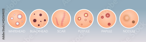set skin scar whitehead pustule blackhead papule pimples different acne types face pore comedones cosmetology skincare problems concept flat horizontal