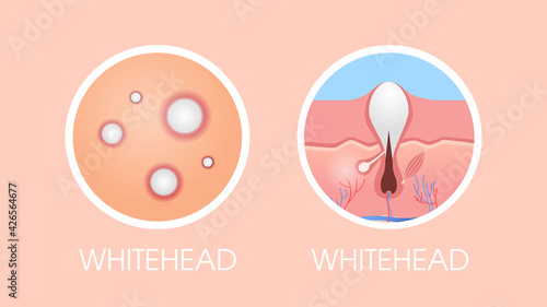 skin whitehead pimples acne type face pore comedones cosmetology skincare problems concept flat horizontal
