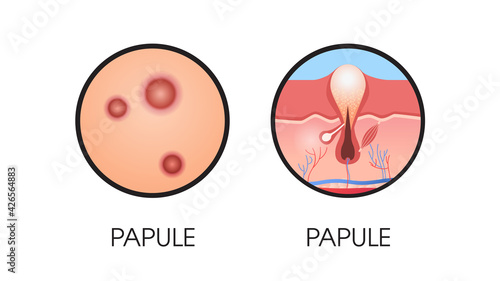 skin papule pimples acne type face pore comedones cosmetology skincare problems concept flat horizontal