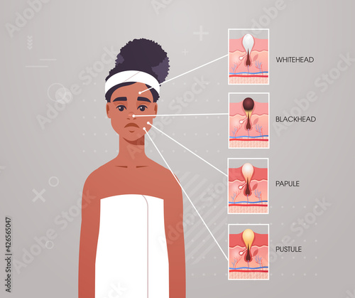 different types of facial skin acne pustule papule blackhead whitehead pimples on woman face pore comedones cosmetology skincare problems concept flat portrait