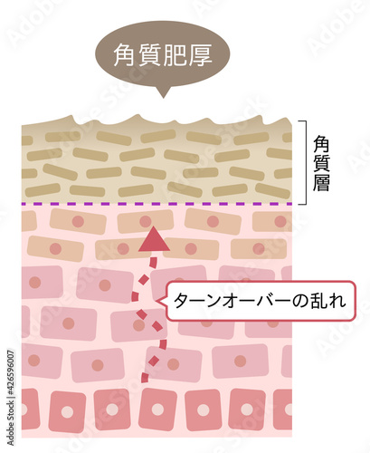 角質肥厚　断面図