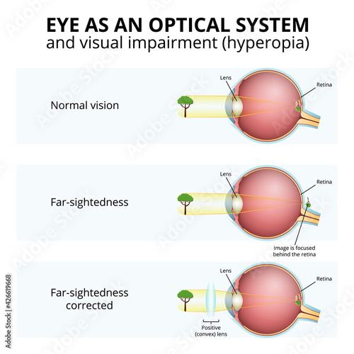 structure of the eyeball, visual impairment, farsightedness