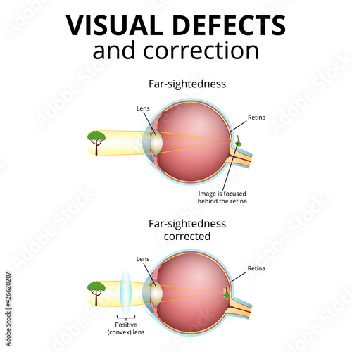structure of the eyeball, visual impairment, farsightedness