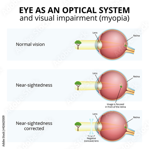 structure of the eyeball, visual impairment, near-sightedness