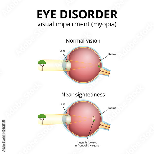 structure of the eyeball, visual impairment, near-sightedness