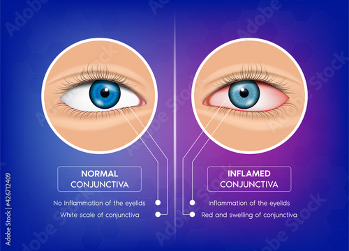 Normal conjunctiva and Conjunctivitis. Healthy eye and pink eye. Most common eye problems glaucoma, dry eye syndrome. Human eye anatomy in front view. 3D Vector EPS10 illustration photo