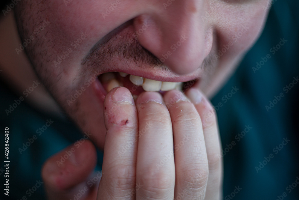 bad  the nails. A hand with some ugly nails. disgusting bitten  fingernails. Nervous man biting his nails in the street. male close-up,   a perfect photo, yellow teeth Stock Photo |