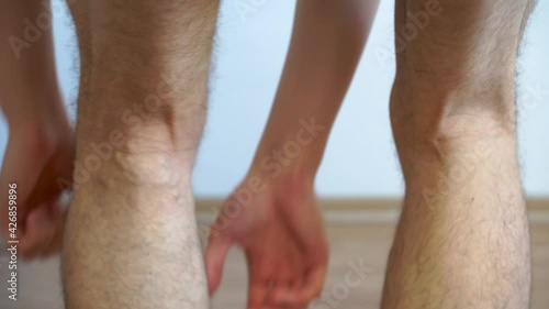 Painful varicose and spider veins on young male legs. Health risk