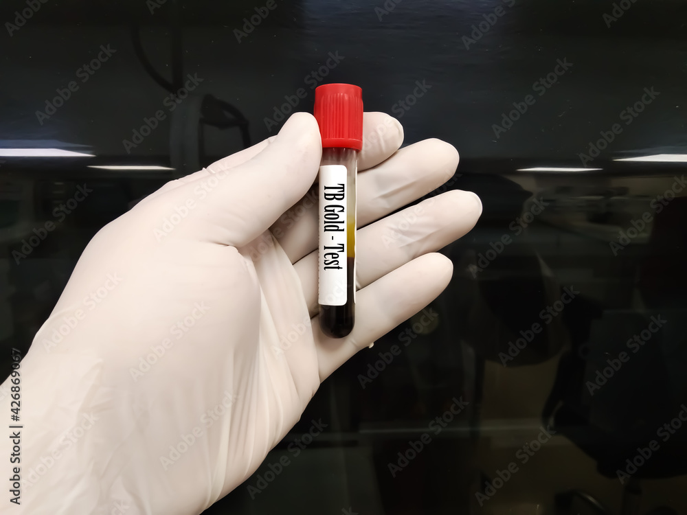 Test tube with blood sample for QuantiFERON or TB Gold test, diagnosis ...