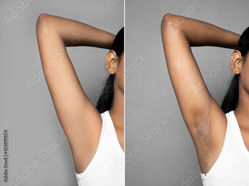 Asian woman with underarm before and after skincare cosmetology armpits epilation treatment concept.  black armpit in a woman.
