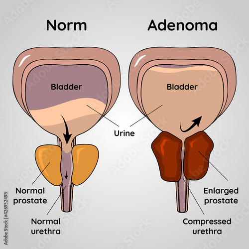 Benign prostatic hyperplasia. Normal bladder and BPH problem. Pain in male reproductive system concept. Human internal organs, prostate gland, bladder anatomy, prostate adenoma medical vector illustra