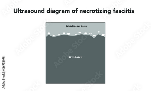 ultrasound diagram of necrotizing fasciitis