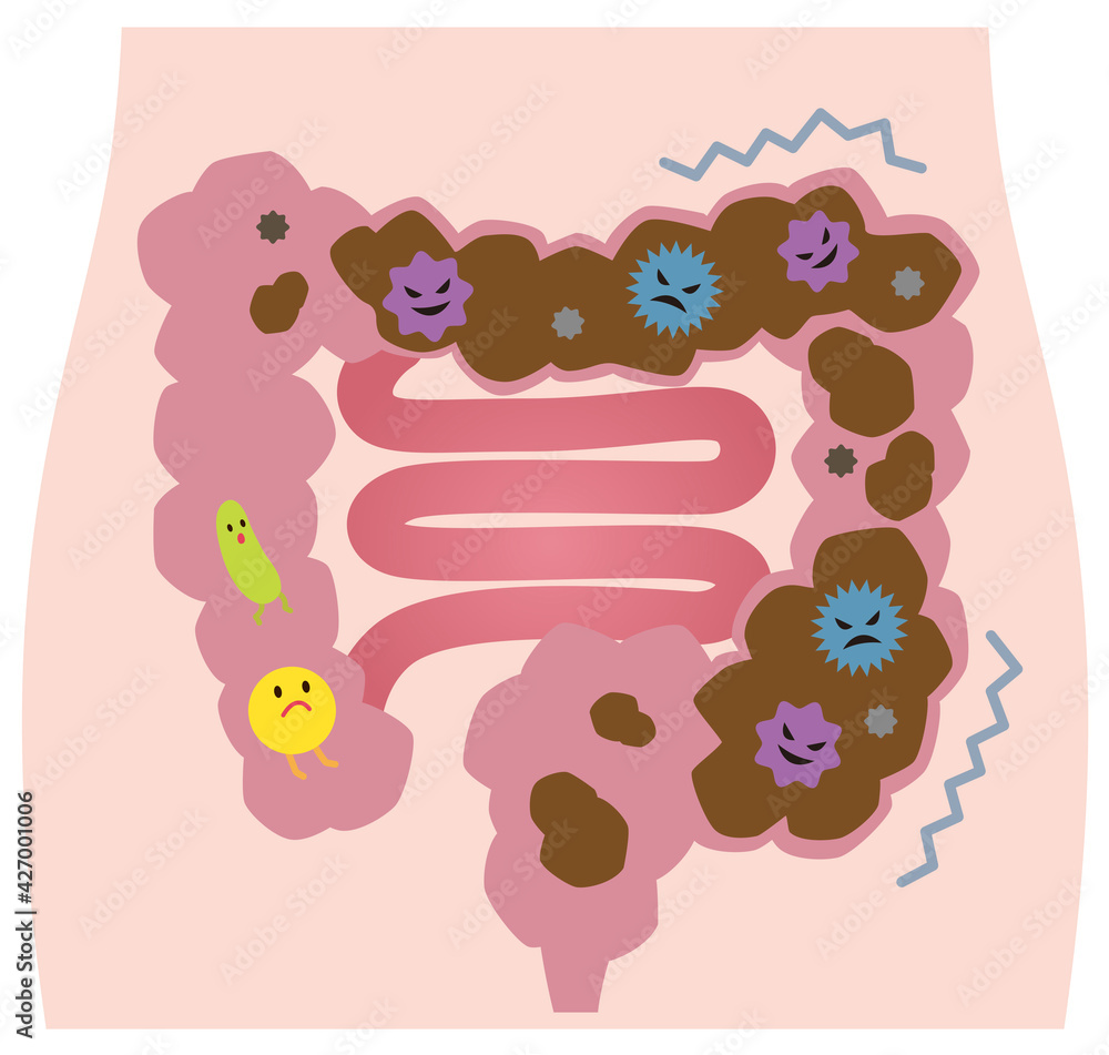 便秘の大腸 腸内環境 悪玉菌 Stock イラスト Adobe Stock 便秘の大腸 腸内環境 悪玉菌 Stock イラスト Adobe Stock