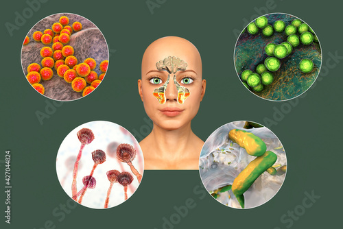 Anatomy of rhinosinusitis and microorganisms that cause sinusitis photo