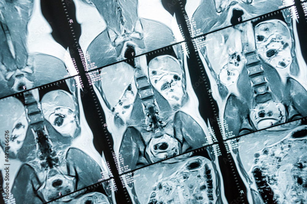 Bild einer Magnetresonaztomographie, MRT, Computertomographie, Röntgenbild.  Bereich des Becken mit Nieren, die von Tumoren befallen sind. foto de Stock  | Adobe Stock