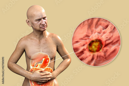 A patient suffering from stomach ulcer with highlighted inner organs of digestive system and close-up view of peptic ulcer photo