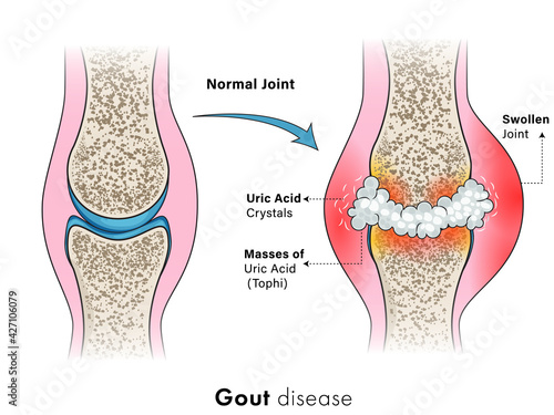 Illustration of Gout autoimmune disorder, disease.