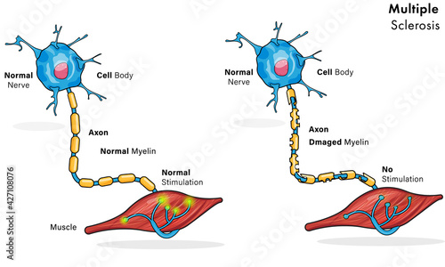 Illustration of nerve condition in Multiple sclerosis disease.