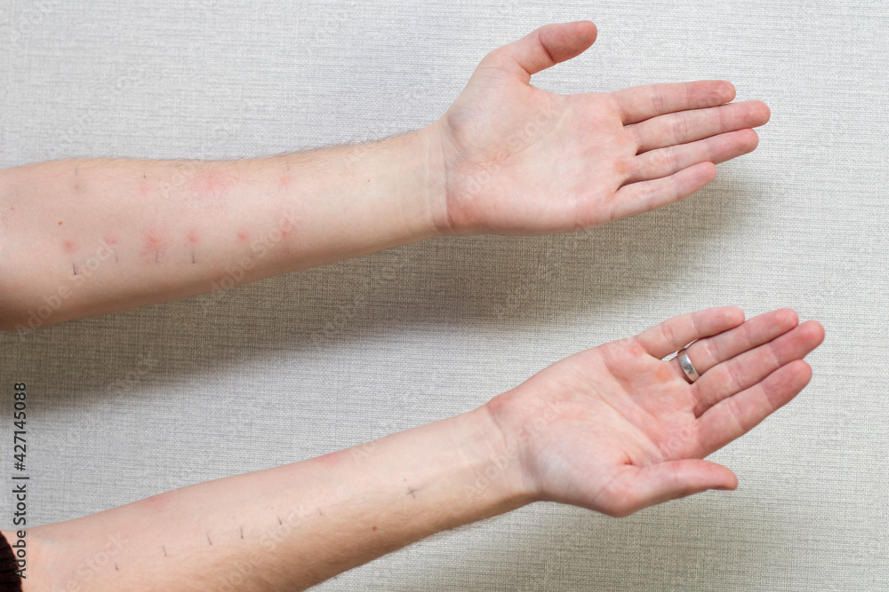 Fototapeta premium Male hands with positive allergy tests. Allergy tests on the arms