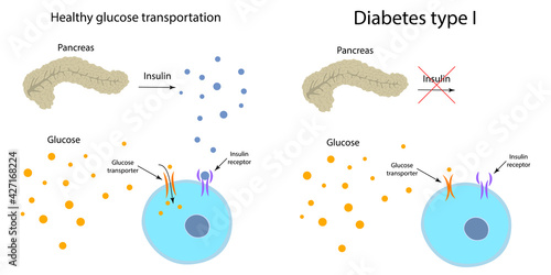 Diabetes type 1 and healthy transportation comparison. Pancreas, insulin receptor, glucose transporter, cell.