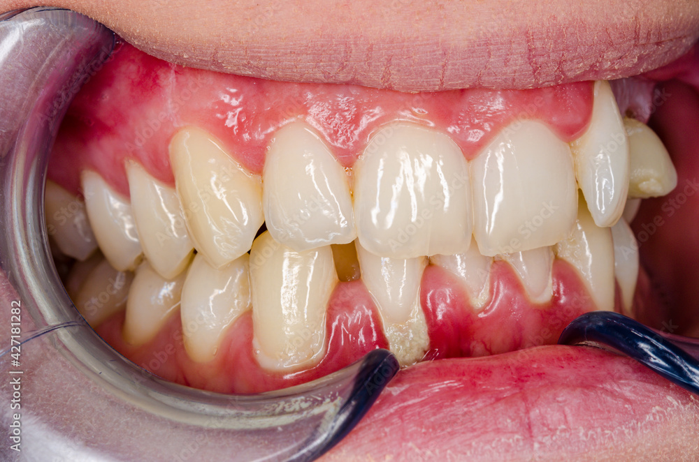 close up of teeth with gingivitis