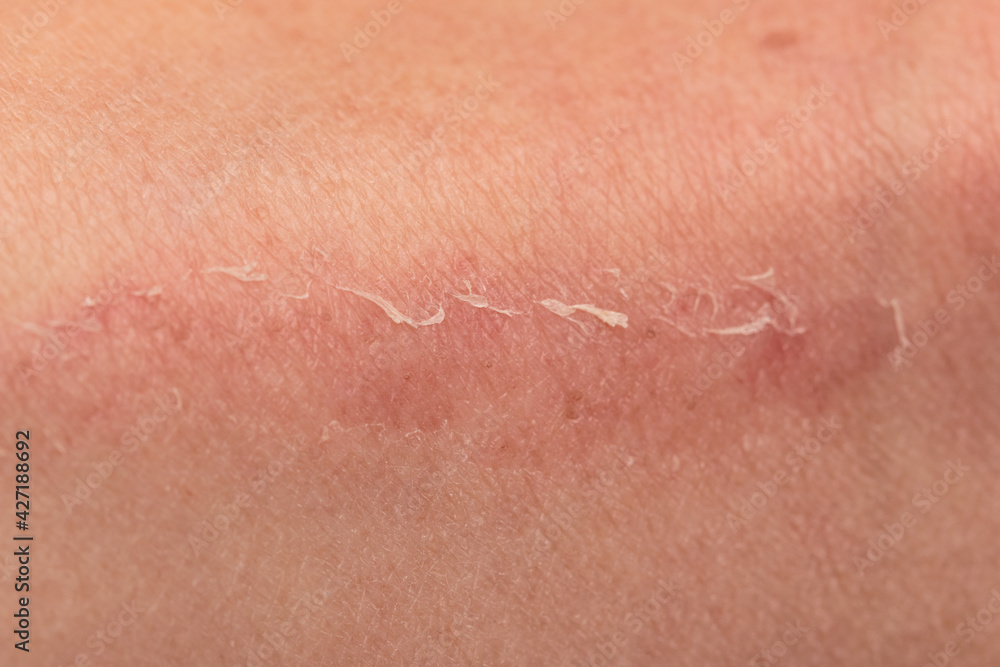 Fototapeta premium scratch on the skin of the leg as a background