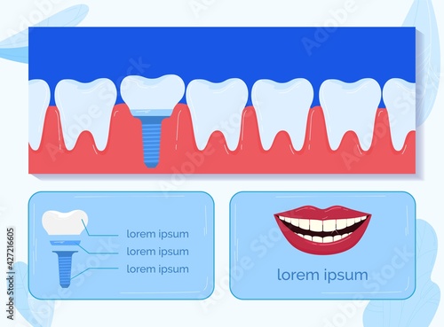 Dentistry dental, tooth mouth, dentist medicine, medic health, implant root, dentin crown, design, flat style vector illustration.