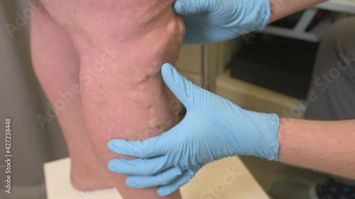 phlebologist or vascular surgeon examines the varicose veins of the lower extremities of a patient in a modern dermatological clinic.