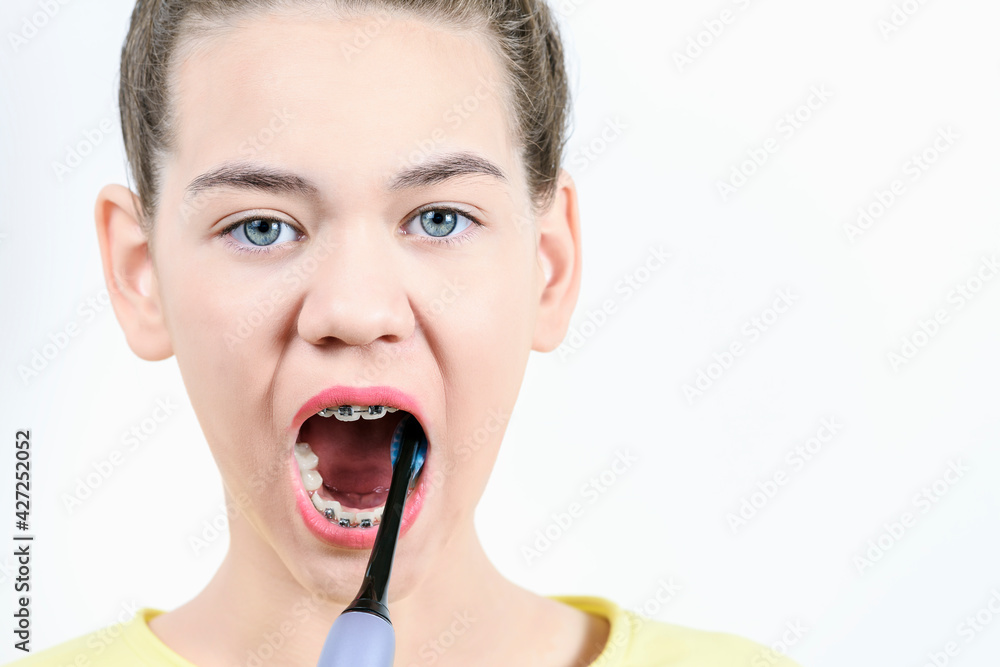 The girl brushes toothbrush with braces. Concept of dentistry and installation of braces. The girl brushes toothbrush with braces. Concept of dentistry and installation of braces.