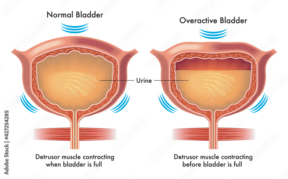 Medical illustration compares a normal bladder to an overactive bladder, with annotations. - obrazy, fototapety, plakaty 