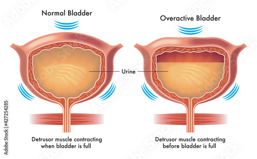Medical illustration compares a normal bladder to an overactive bladder, with annotations.