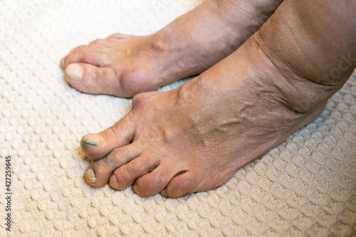 inflammatory disease of the toes of a middle-aged woman. inflammation of the toes due to gout or arthritis. toes affected by Gout