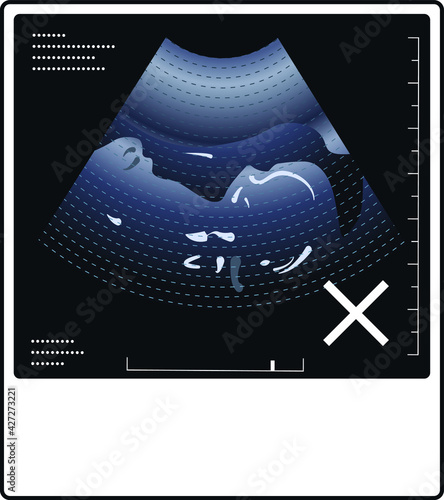 Ultrasound photo of a fetus with a gender indeterminate symbol.