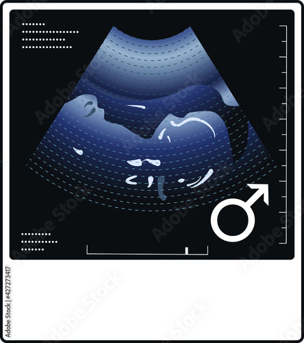 Ultrasound photo of a fetus with a gender male symbol.