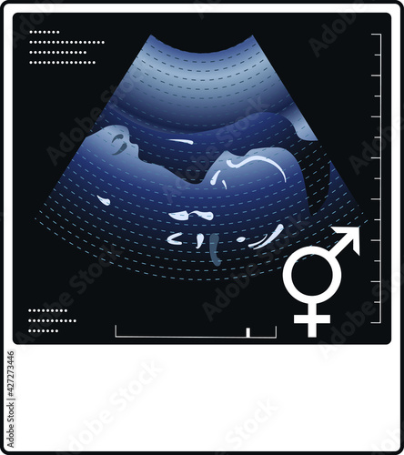 Ultrasound photo of a fetus with a gender non-binary symbol.